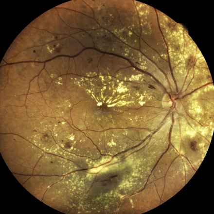 Close up photogragh of an eye with Age Related Macular degeneration