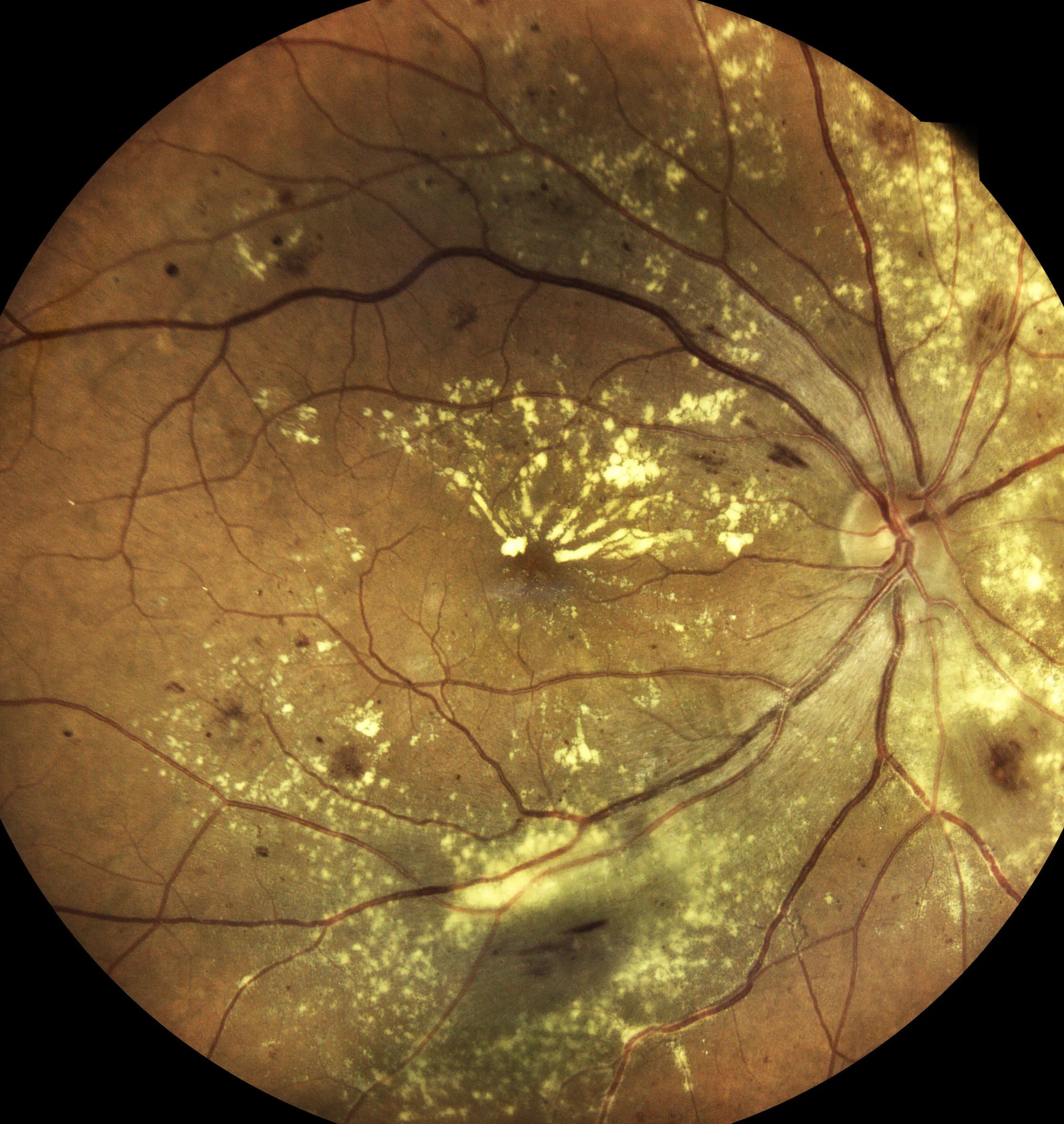 close up scan of the eye and macular disease